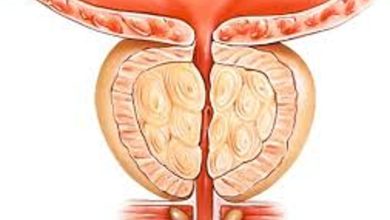 Selim Prostat Büyümesi (Benign Prostat Hiperplazisi-BPH)