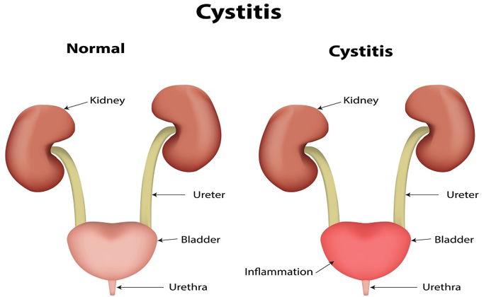 Цистит у мужчин. Diseases of the bladder and Urinary tract. Diseases of the bladder and Urinary tract Pharmacy. Diseases of the bladder and Urinary tract Pharma. Urinary gap.