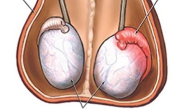 Testiküler Adrenal Rest Tümör